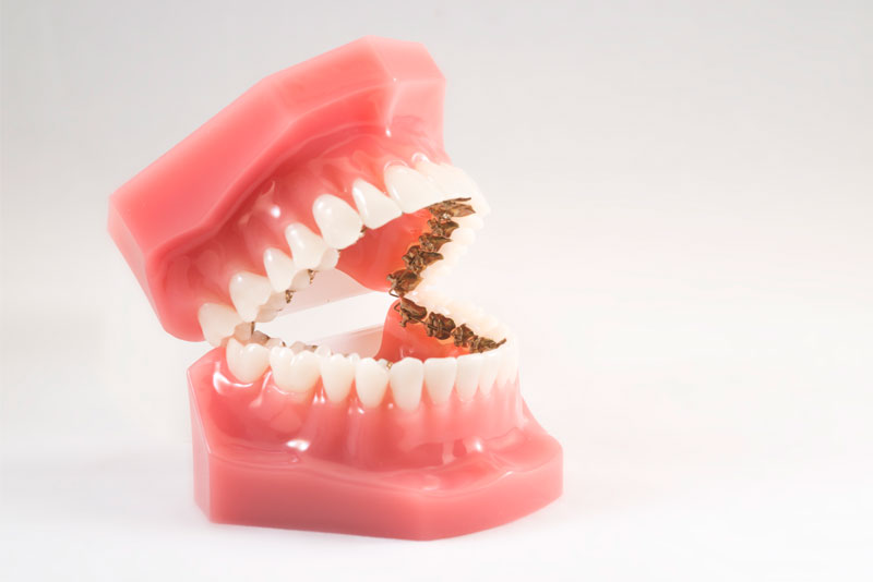 В чем разница между брекетами и элайнерами — отвечает стоматолог — Сноб